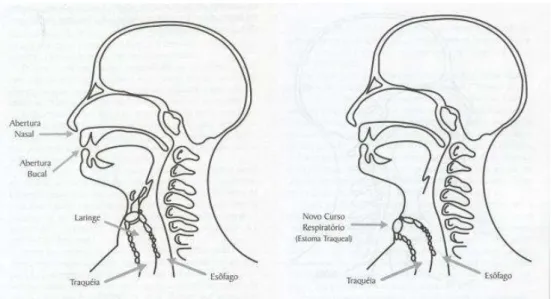 FIGURA 2: Passagem de ar fisiológica e após cirurgia de laringectomia total (FONSECA,  2002) 