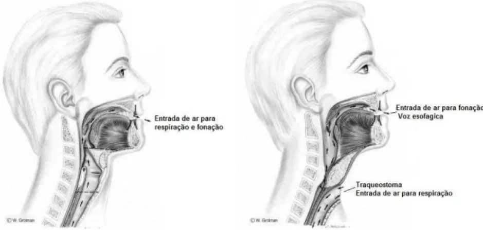 FIGURA 3: A- Imagem anterior a laringectomia total. B- após a laringectomia total com  descrição  da  entrada  de  ar  para  produção  de  voz  esofágica  (adaptadas  de  GROLMAN,  1998) 