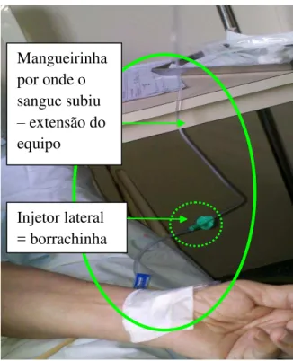 Figura 5 - Equipo conectado ao polifix para o paciente receber medicação, com destaque  para o injetor lateral (borrachinha) e a extensão (mangueirinha)