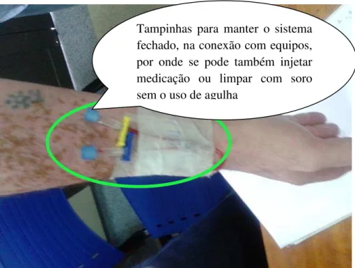 Figura  7  -  Polifix  com  duas  entradas/acessos  instalados  com  jelco  (agulha  de  silicone  instalada na veia do paciente, acesso venoso) em braço de paciente 