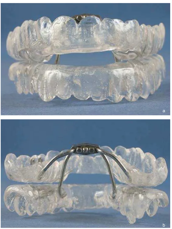 Figura 4.5-  Placa de avanço mandibular confeccionada para esta pesquisa, vista ântero- ântero-posterior (a) e póstero-anterior (b) 
