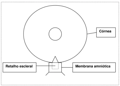 Figura 1: Desenho esquemático da membrana amniótica suturada sobre o  retalho escleral superficial nos 31 pacientes do grupo estudo