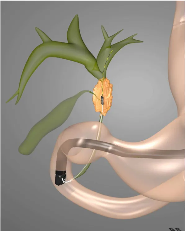 Figura 2 -  Imagem  artística  do  escovado  citológico  de  lesão  acometendo  via  biliar  durante o exame de CPRE 