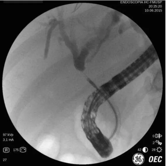Figura 4 -  Imagem fluoroscópica da pinça de biópsia na via biliar principal durante a  CPRE 