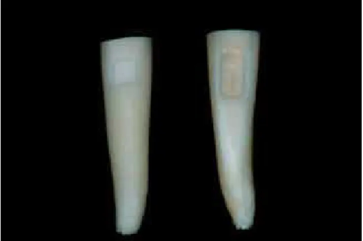 Fig. 4- Preparos cavitários:  A - cavidade de  3 mm  e B - cavidade de 6mm