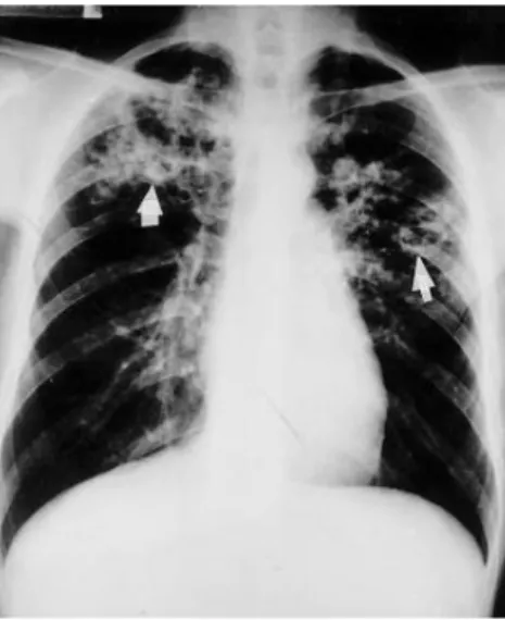 Figura 1.9 – Radiografia ao tórax na posição póstero-anterior, onde se podem ver  opacidades heterogéneas em ambos os pulmões (Bombarda et al., 2001)