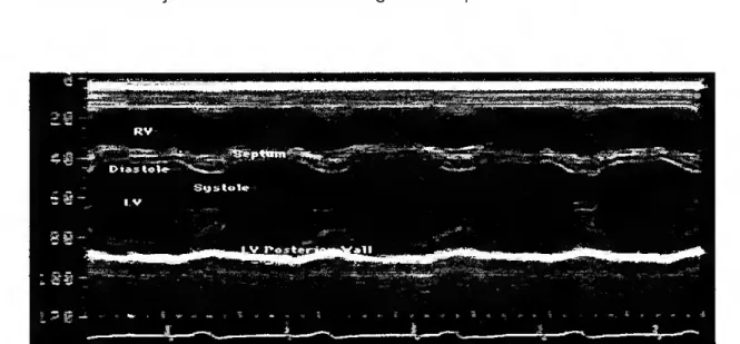 Figura 1.6 - Exemplo de ecocardiografia modo-M. imagem do funcionamento dum ventrículo  esquerdo normal, (proveniente da internet) 