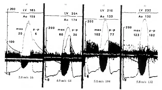 Figura 4.2 - Espectro Doppler de onda contínua em simultâneo com as respectivas pressões no  ventrículo esquerdo e na aorta, em quatro pacientes com diferentes níveis de estenose aórtica,  (proveniente de Feigenbaun, Harvey; Echocardiography
