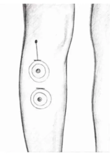 Figura 14a e 14b – Posicionamento dos eletrodos no músculo tibial anterior – Fig. 