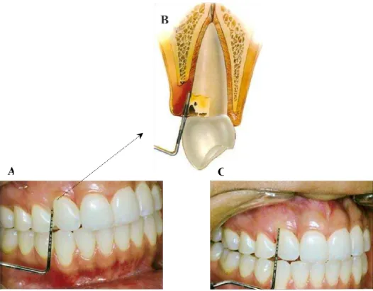 Figura 3 –  Ilustração  do  procedimento de sondagem periodontal. A. Sonda  periodontal introduzida no sulco gengival para obter a PCS; B