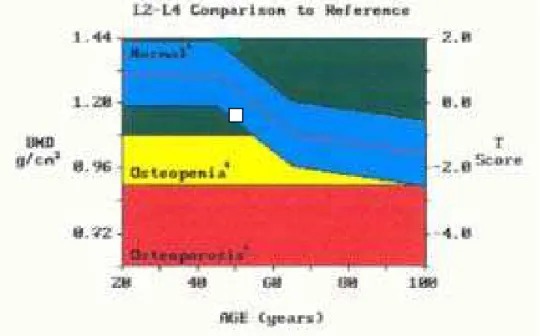 Figura 7 -  Gráfico demonstrativo resultante da densitomeria óssea da coluna  lombar realizada em aparelho Densitômetro DPX-IQ Lunar, mostrando  densidade mineral óssea de 1.30g;cm2 num individuo de 50 anos