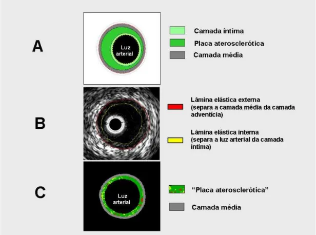 Figura  6  –   Definição  dos  limites  da  placa  aterosclerótica  ao  ultrassom  intracoronário  em  escala  de  cinza  e  pela  técnica  de  histologia  virtual