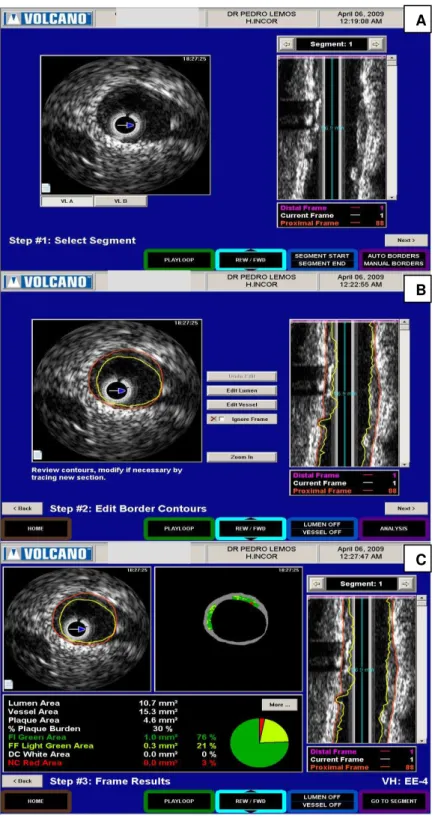 Figura  7  –   Análise  das  imagens  de  ultrassom  intracoronário  pela  técnica  de  histologia virtual com o programa PcVH 2.2