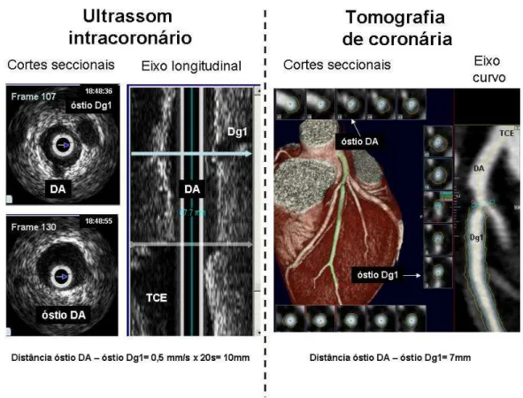 Figura  8  –   Pareamento  dos  segmentos  vasculares  a  serem  comparados  ao  ultrassom  intracoronário  e  à  tomografia  de  coronária