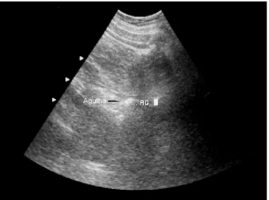 Figura 7:  Imagem  obtida  por  ultra-sonografia  após  o  esvaziamento  completo do cisto renal