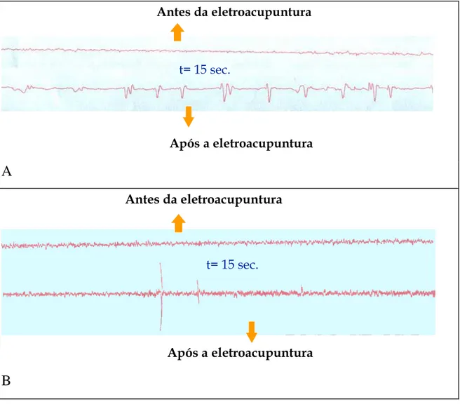 FIGURA 7. Aumento da atividade elétrica após 90 minutos de eletroacupuntura. Embora os padrões  das figuras A  e B sejam diferentes, o aumento da atividade elétrica é patente nos dois  casos