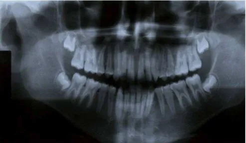 Figura 2B – Radiografia panorâmica de mandíbula pré-operatória. 