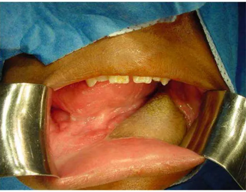 Figura 2G - Aspecto tardio da ilha de pele do retalho de fibula posicionada dentro da  cavidade oral 