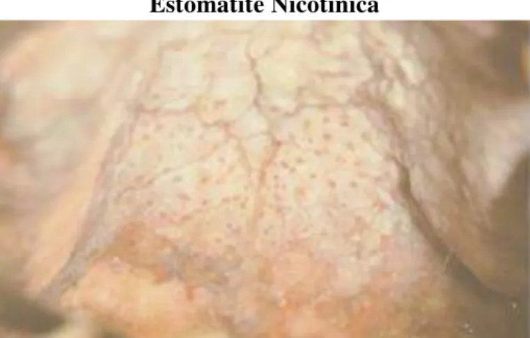 Figura 6 - Estomatite Nicotínica (Neville, B.W. e Day, 2002) 
