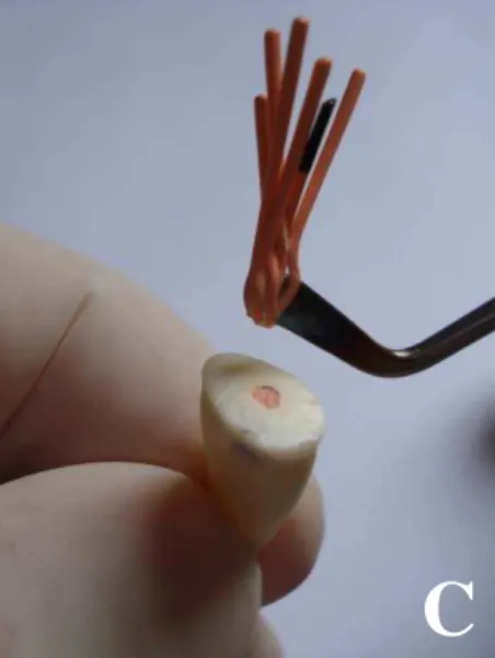 Figura 4. C: tratamento endodôntico 