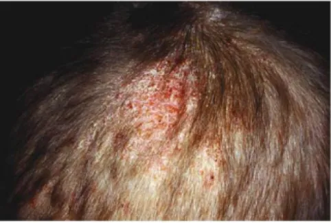 Figure 1: Tinea capitis kerion-type (10). 