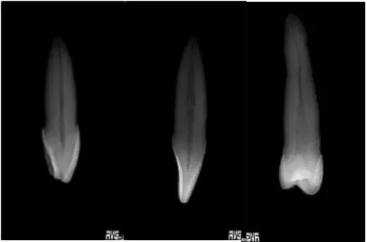 Figura 1- Radiografias RVG ®  usadas na seleção dos dentes 