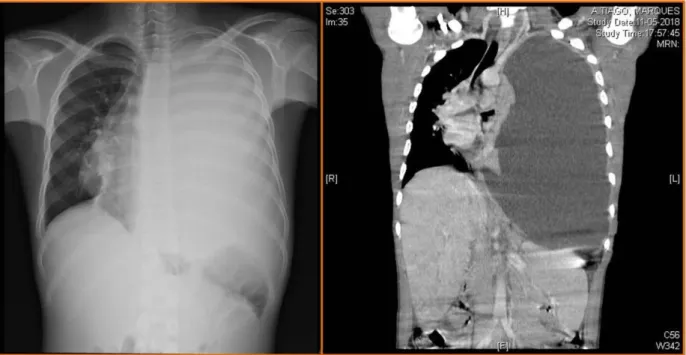 FIGURA 2 (ESQUERDA) – Radiografia torácica realizada à admissão  FIGURA 3 (DIREITA) – TC tórax realizada à admissão 