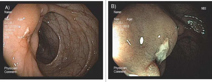 Figura  1.  Paciente  com  doença  de  Crohn  e  úlcera  no  cólon  ascendente.  a)  Colonoscopia de alta resolução mostrando: A) ulceração; B) Colonoscopia com  Narrow  Band  Image  (NBI)  com magnificação,  mostrando detalhes  da mucosa  periulceração  c