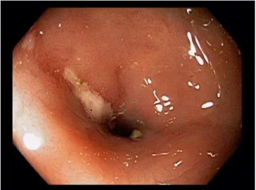 Figura  2.  Colonoscopia  de  alta  resolução.  Paciente  com  doença  de  Crohn  complicada  por  estenose  em  transição  do  cólon  transverso  para  o  descendente;  uma  úlcera  é  vista  marginalmente  à  estenose