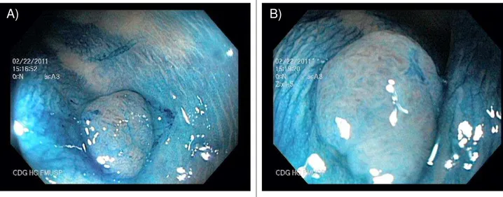 Figura  6.  Colonoscopia  com  cromoscopia  em  paciente  com  doença  de  Crohn; A) pólipo séssil de 12 mm visto na região do ceco após cromoscopia; B)  magnificação  revelando  padrão  de  cripta  (Pit  Pattern)  IV