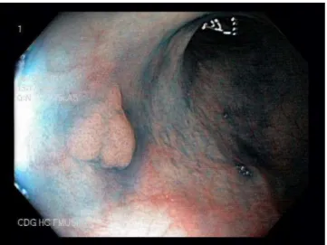Figura  7.  Colonoscopia  por  cromoscopia  em  paciente  com  doença  de  Crohn;  lesão  polipoide  de  12mm  em  sigmoide,  com  padrão  de  cripta  (Pit  Pattern)  tipo  IIIL;  exame  anatomopatológico  revelou  adenoma  tubular  com  displasia de baixo