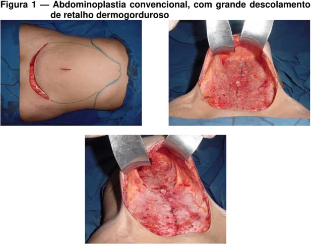 Figura 1 — Abdominoplastia convencional, com grande descolamento  de retalho dermogorduroso 