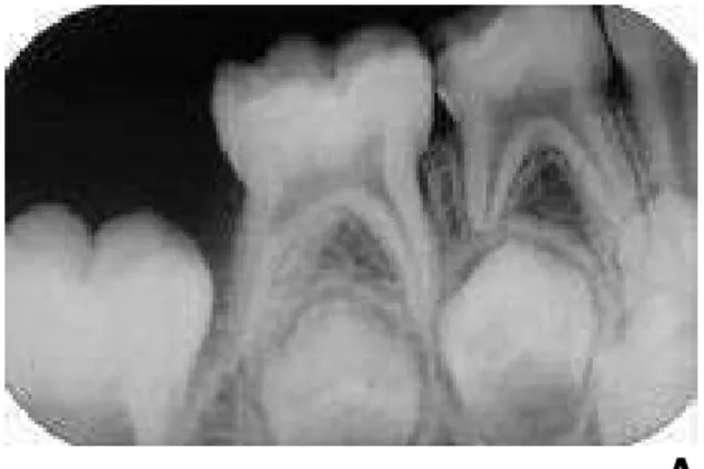Figura 3 – Pulpotomia do dente 74 com Hidróxido de cálcio (sucesso radiográfico) – Grupo II  A - Radiografia inicial 