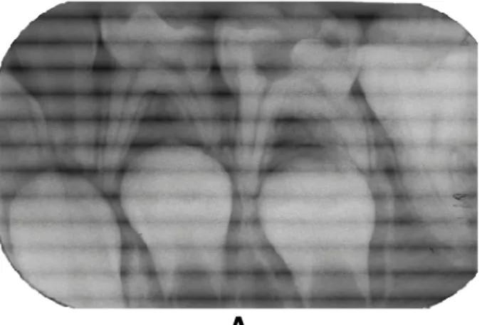 Figura  4  –  Pulpotomia  do  dente  84  com  Hidróxido  de  cálcio  (insucesso  radiográfico)  -  Grupo  II  Pulpotomia do dente 85 com Formocresol (sucesso radiográfico) – Grupo I 
