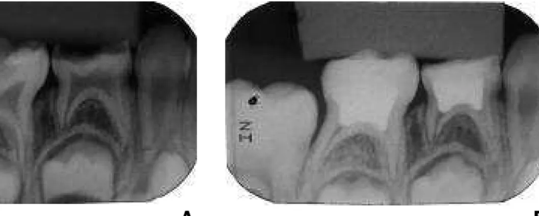 Figura  5  –  Pulpotomia  dos  dentes  84  e  85  com  Laser  de  Baixa  Intensidade  +  OZE  (sucesso  radiográfico) – Grupo III 