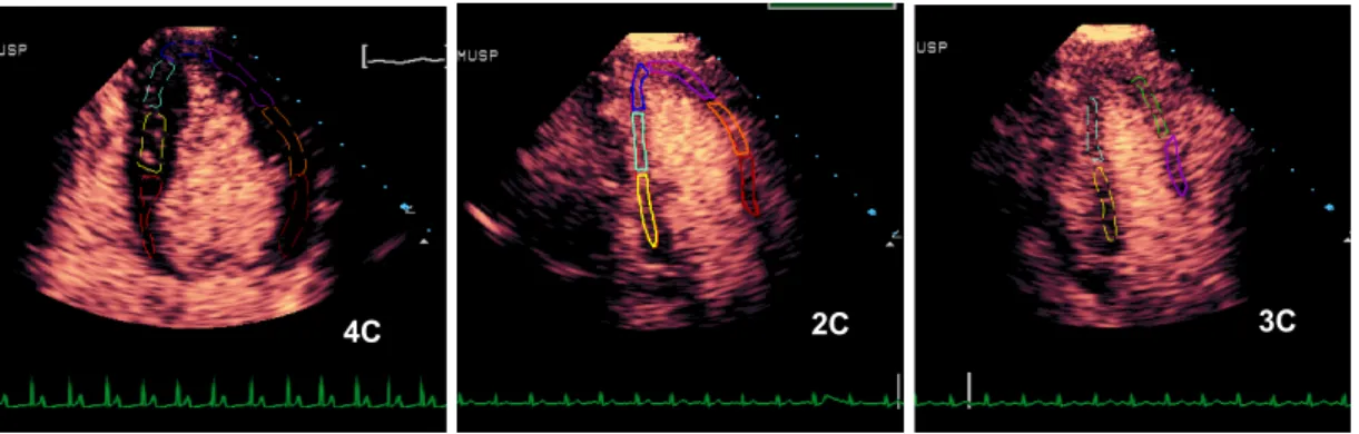 Figura 9 -  Disposição das regiões de interesse nos 17 segmentos do ventrículo esquerdo  durante a análise da perfusão miocárdica pela ecocardiografia de perfusão  miocárdica em tempo real no software Q-Lab 2.0 ® (Philips Medical Systems,  Bothell, WA, USA