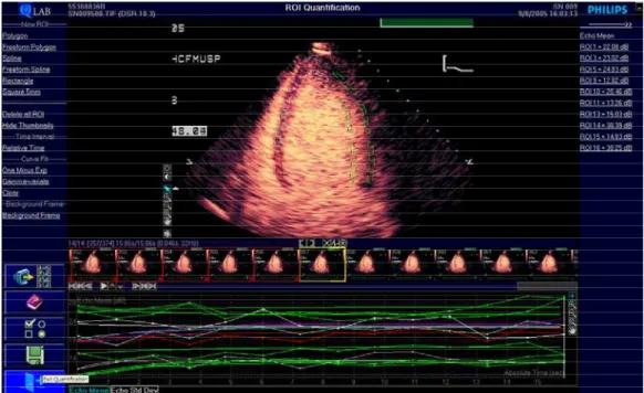 Figura 10 -  Quantificação da perfusão miocárdica pelo software Q-Lab ® (Philips Medical  systems, Bothell, WA, USA)