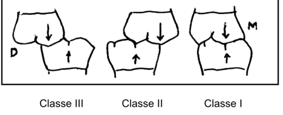 Figura 1 -  Desenho esquemático da relação entre os primeiros molares-  Classificação de Angle (D – distal, M – mesial)