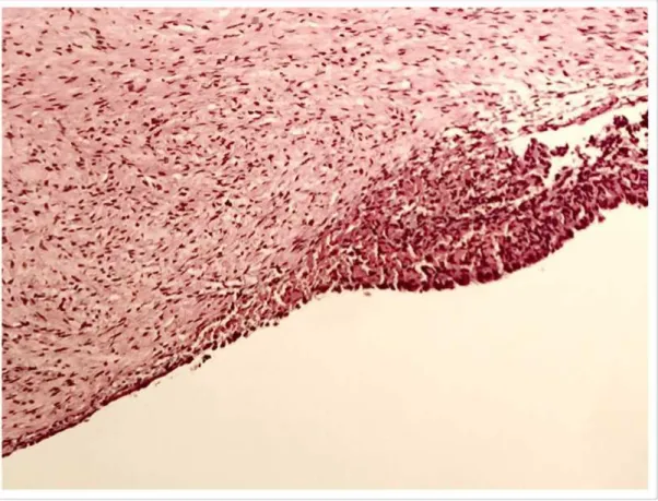 Figura 6 -  Fotomicrografias ópticas de espécimes de endometriose ovariana  tipo estromal puro (HE - 20x) 