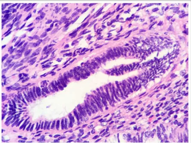 Figura 7 -  Fotomicrografias ópticas de espécimes de endometriose ovariana  tipo endometrioide (HE - 40x) 