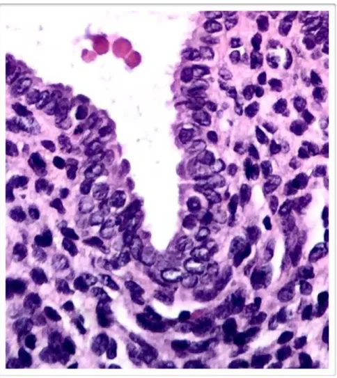 Figura 8 -  Fotomicrografias ópticas de espécimes de endometriose ovariana  tipo tuboendometrioide (HE - 40x) 