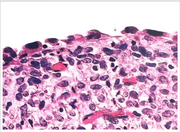 Figura 9 -  Fotomicrografias ópticas de espécimes de endometriose ovariana  tipo indiferente (HE - 40x) 