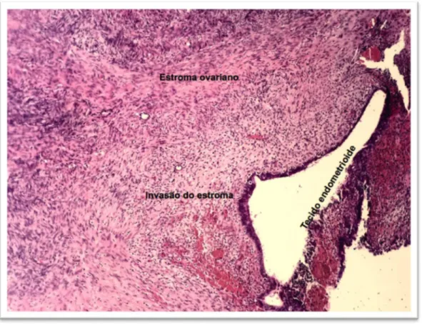 Figura  14  -  Fotomicrografia óptica de espécimes de endometriose ovariana  forma peritoneal infiltrativa (HE - 20x) 