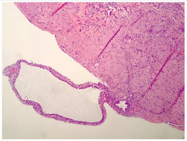 Figura  15  -  Fotomicrografia óptica de espécimes de endometriose ovariana  forma peritoneal não infiltrativa (HE - 10x) 