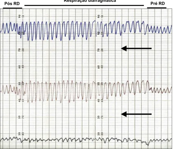 Figura 7.  Traçado de “Respitrace  ” de um paciente com DPOC grave nos  momentos pré, durante e após a RD 
