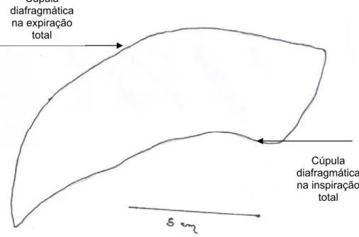 Figura 1a. Imagem digitalizada representando a área compreendida entre as cúpulas                     diafragmáticas à direita na inspiração e expiração total – incidência PA 