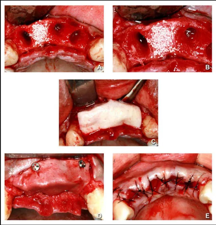 Figura 3. A e B: Colocação do enxerto (MOI/P-15) no alvéolo correspondente ao  dente 21; C: Posicionamento da MDA; D: Fixação da MDA com parafusos de titânio; 