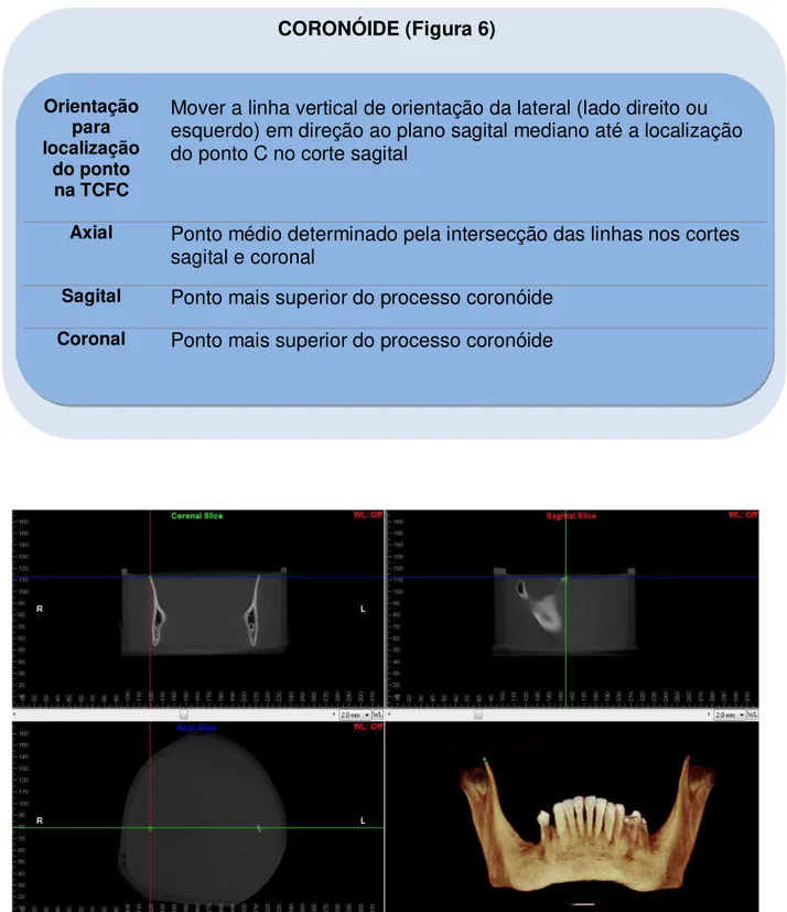 Figura 6 – Identificação do ponto coronóide. 