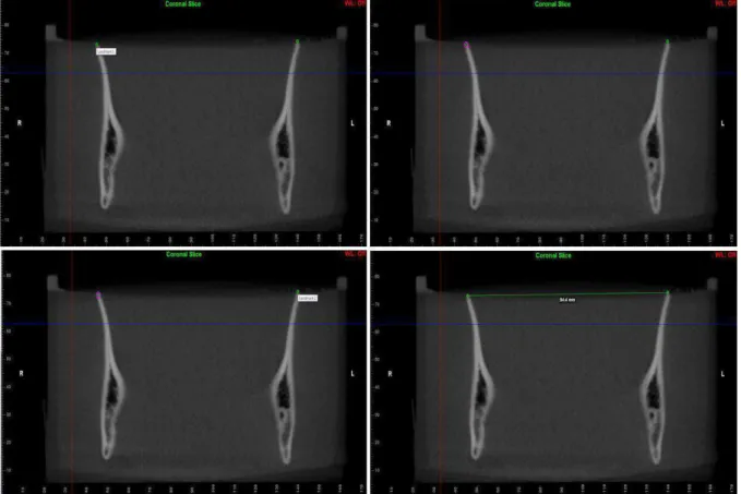 Figura 10 - Distância intercoronóide nos cortes multiplanares. 