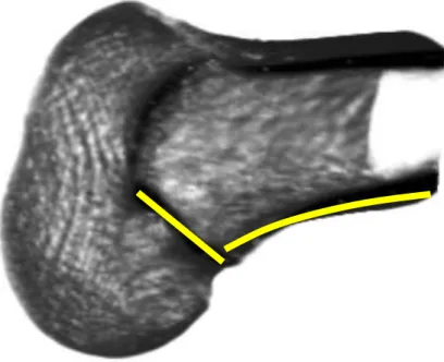 FIGURA  6.  Reconstrução  tomográfica  do  côndilo  femoral  lateral  e  relações  topográficas entre a linha de Blumensaat e o córtex posterior do fêmur